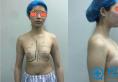 去面诊重庆爱思特刘中林2次才确定做大腿吸脂和自体脂肪隆胸