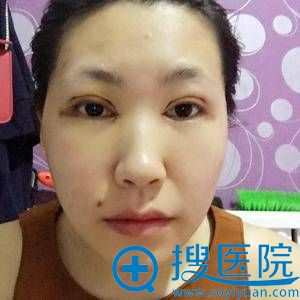 <!--<i data=20240710 data-id=7743></i>-->刚做完双眼皮图片 <!--<i data=20240710 data-id=7743></i>-->刚做完双眼皮图片