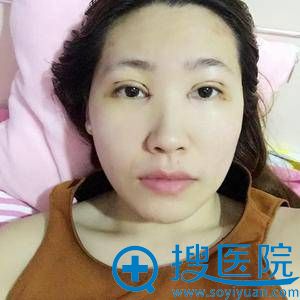 找北京谢双灵做全切双眼皮7天后 找北京谢双灵做全切双眼皮7天后