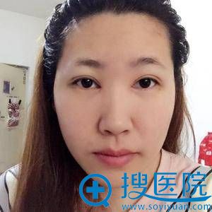 <!--<i data=20240710 data-id=7743></i>-->谢双灵割双眼皮案例 <!--<i data=20240710 data-id=7743></i>-->谢双灵割双眼皮案例