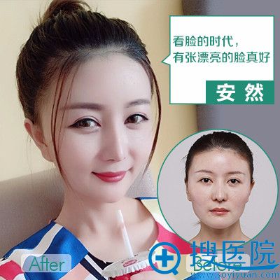 重庆华美陈熏做的颧骨和下颌角整形案例