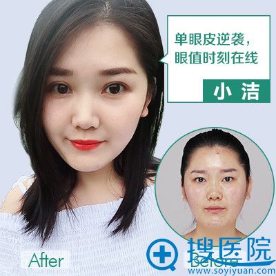 重庆华美何春涛做的双眼皮案例