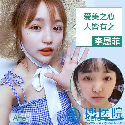 重庆华美何春涛医生做的隆鼻案例