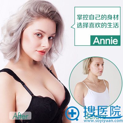重庆华美整形医院陈德法隆胸案例