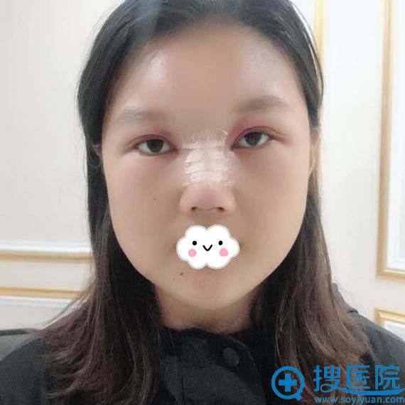 新疆梁青松假体隆鼻+下巴整形真人案例