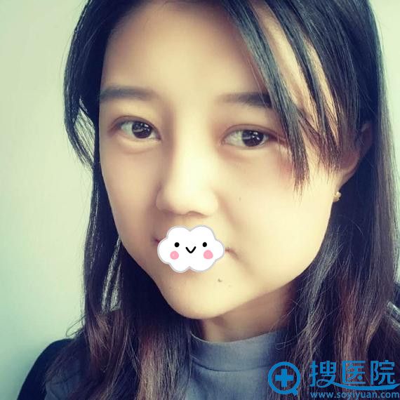 新疆梁青松假体隆鼻+下巴整形案例效果图