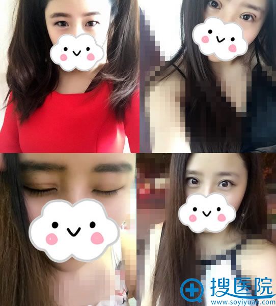 韩国碧夏整形李珉奭院长双眼皮案例