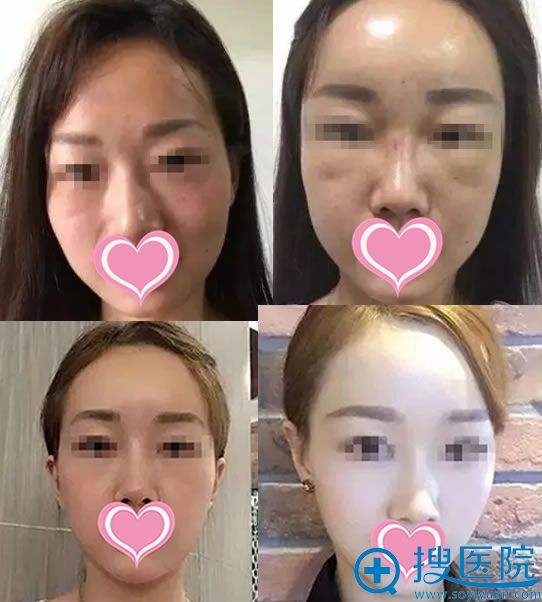 韩国碧夏李珉奭院长脂肪填充案例