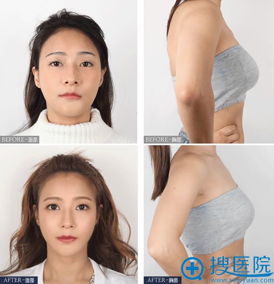韩国faceline菲斯莱茵轮廓和胸部修复案例
