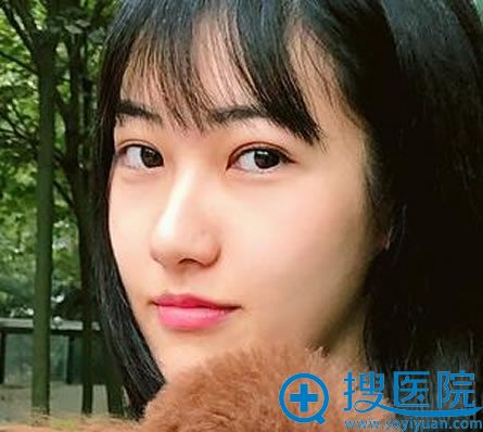 北京华韩柳民熙隆鼻案例3个月效果