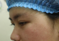 之前在上海明桥整形医院做过双眼皮这次又来找孙超医生做隆鼻