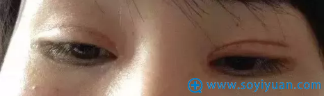 双眼皮整形失败案例