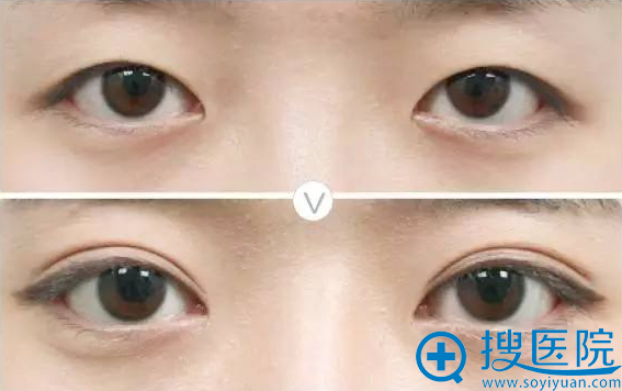双眼皮真人案例效果对比图