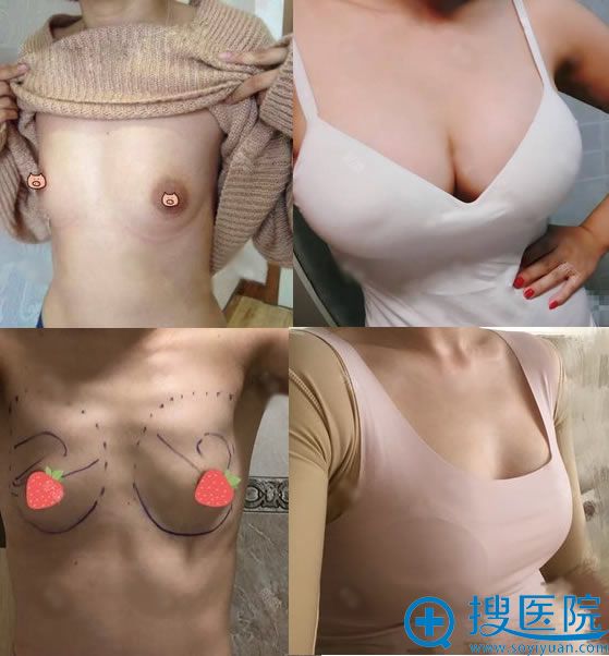 北京东方和谐冯斌自体脂肪隆胸案例