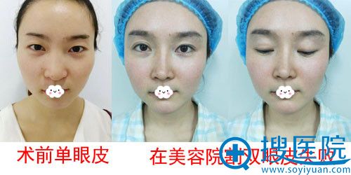 成都<!--<i data=20240710 data-id=16572></i>-->眼整形与修复医学研究院双眼皮失败修复案例