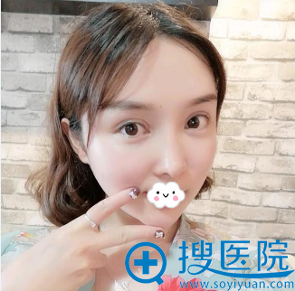 成都莱尹<!--<i data=20240710 data-id=16572></i>-->双眼皮失败修复真人案例