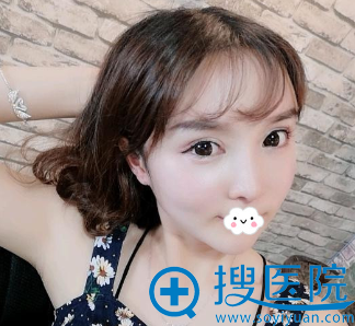成都莱尹<!--<i data=20240710 data-id=16572></i>-->双眼皮失败修复术后效果图