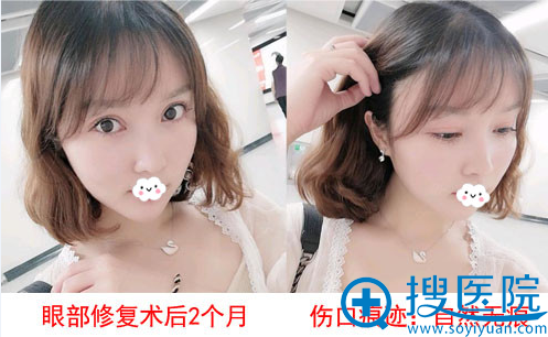 双眼皮失败修复哪家好？成都莱尹<!--<i data=20240710 data-id=16572></i>-->真人案例