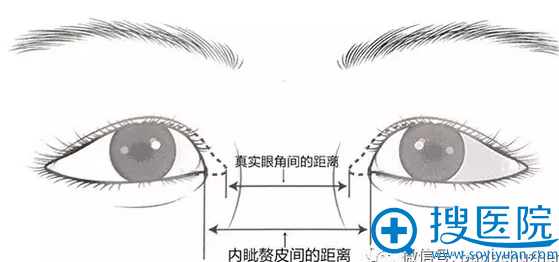开内眼角什么距离合适