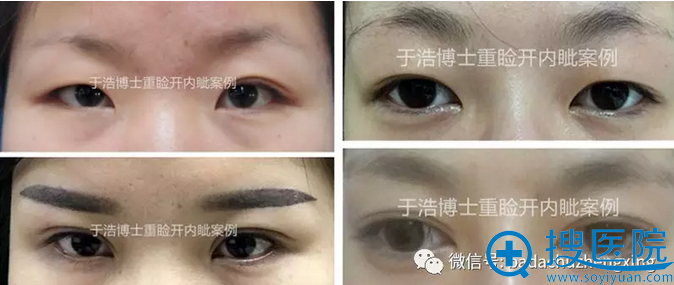 重睑+开内眼角真人案例效果前后对比