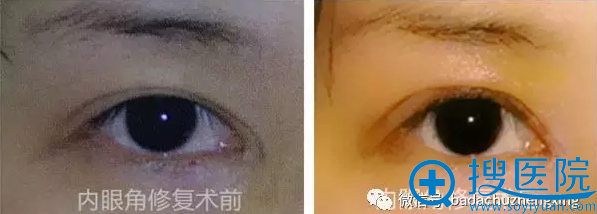 开内眼角失败修复案例效果图对比