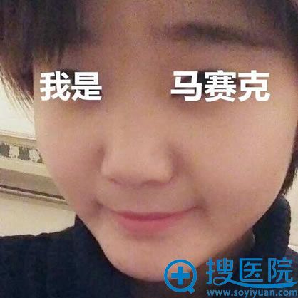 选择淮北微悦做隆鼻手术前