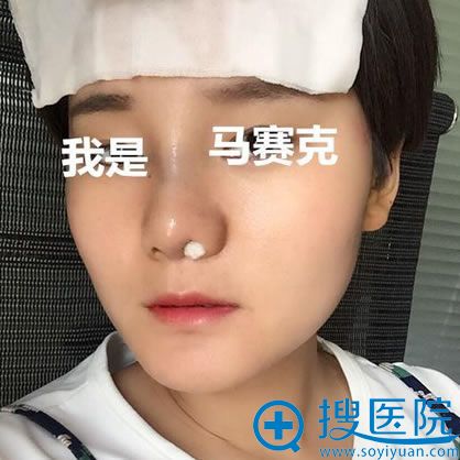 淮北微悦刚做完隆鼻效果图