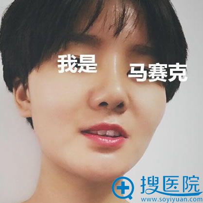 做完硅胶假体隆鼻手术7天后