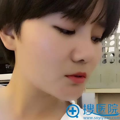 淮北微悦周创业假体隆鼻案例