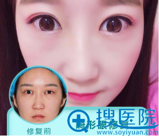 上海美莱杜园园做的双眼皮修复案例