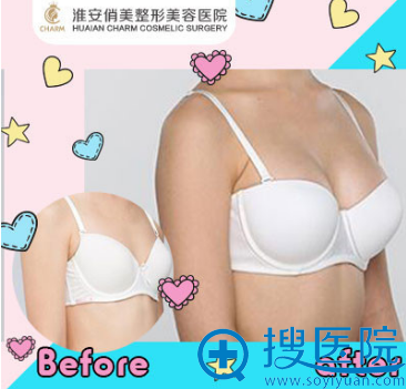 淮安俏美留美博士朱逸隆胸案例 淮安俏美留美博士朱逸隆胸案例
