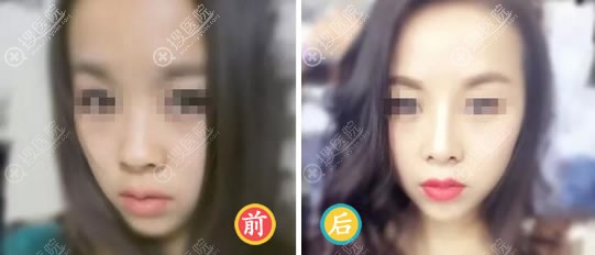 <!--<i data=20240710 data-id=12041></i>-->医美叶武锋鼻综合案例