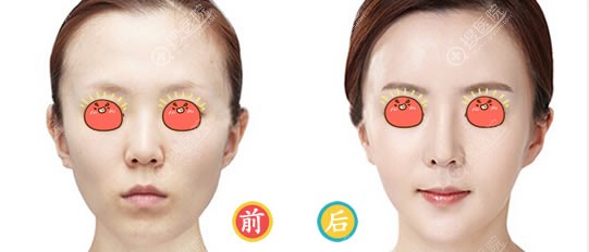 <!--<i data=20240710 data-id=12041></i>-->医美姚春莲自体脂肪填充案例