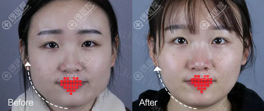 宁波珈禾瘦脸针术后一个对比照片