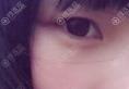 ҽԺƼҷ6mm˫Ƥ1»ָЧ