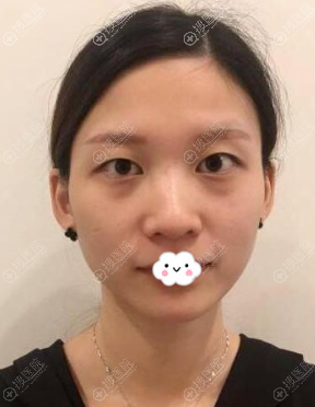 <!--<i data=20240710 data-id=12584></i>-->黄富伟双眼皮+开眼角真人案例