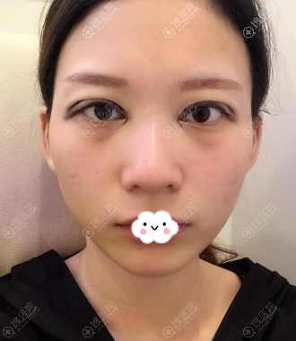 <!--<i data=20240710 data-id=12584></i>-->黄富伟双眼皮+开眼角术后效果
