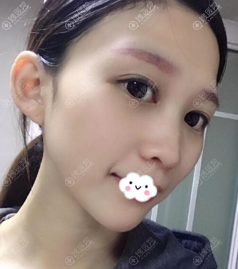 四川<!--<i data=20240710 data-id=12584></i>-->整形医院黄富伟双眼皮效果好吗