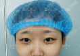 在郑州阳光整形做双眼皮3个月我又找杨小顺做了假体隆鼻垫下巴