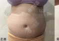 19岁的女孩竟是在杭州连天美做腹部吸脂术变成A4腰的？