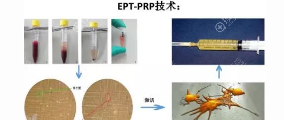 EPT-PRP技术原理及操作过程
