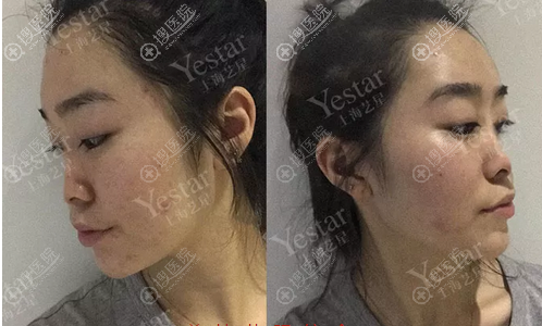 术前单眼皮塌鼻梁照片