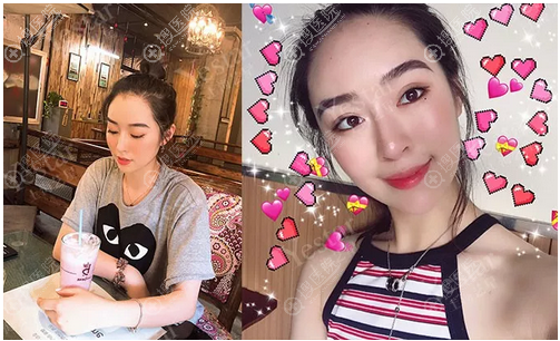 上海yestar黄泽春做的双眼皮隆鼻案例