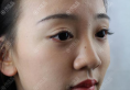 看了上海yestar李建兵的隆鼻案例后直接预约了肋软骨隆鼻手术
