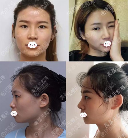 武汉美基元汪福强鼻综合隆鼻案例效果图