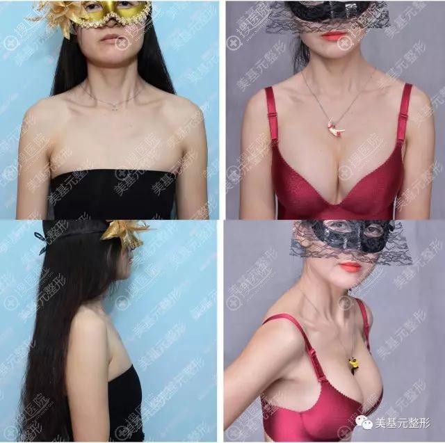 武汉美基元汪福强假体隆胸真人案例