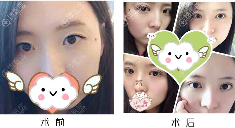 <!--<i data=20240710 data-id=14500></i>-->黄金同双眼皮案例效果对比图