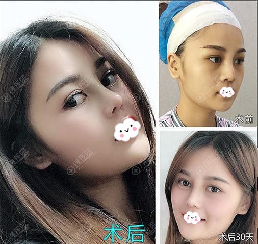 <!--<i data=20240710 data-id=14500></i>-->马炳超肋软骨隆鼻案例效果对比图