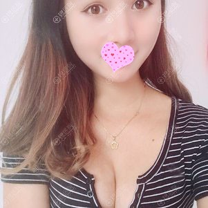 湘谭雅美假体隆胸第20天恢复图