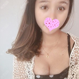 假体隆胸一个月效果图